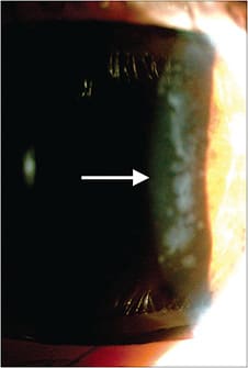 Figure 1. Decentered orthokeratology lenses can cause mechanical insult to the ocular surface such as stromal edema.