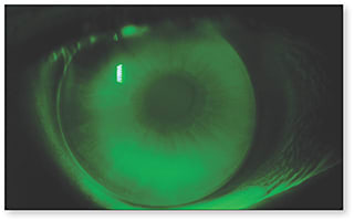 Figure 4. An aspheric corneal GP on an astigmatic and presbyopic eye. Contact lenses with aspheric front surfaces improve subjective vision in some astigmatic patients.