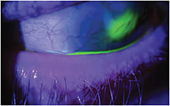 Figure 2. An eye diagnosed with limbal stem cell deficiency experiences yet another epithelial defect upon awakening.