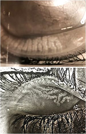 Figure 1. Meibography demonstrates severe meibomian gland tortuosity, dropout, and atrophy.