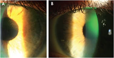 Figure 7. Post-lens tear debris (A) before fluorescein flow under the lens and (B) after instillation of dye and time for the dye to seep under the lens. Note that the dye is accumulating where the debris was localized.