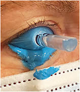 Figure 2. Ocular surface impression procedure.