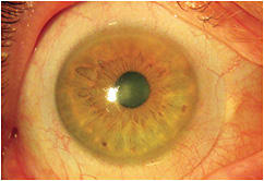 Figure 2. Scleral lens with a spherical landing zone. The fit shows impingement of the pinguecula, with edge lift below.