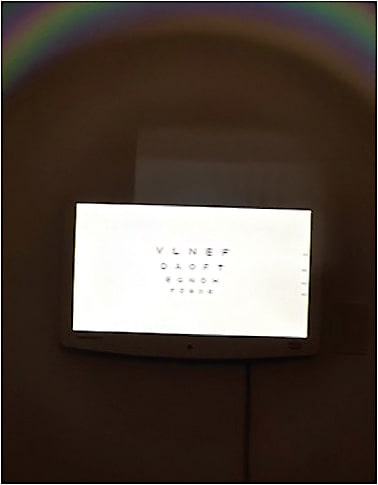 Figure 3. The visual acuity chart with 1.00D of uncorrected cylinder.