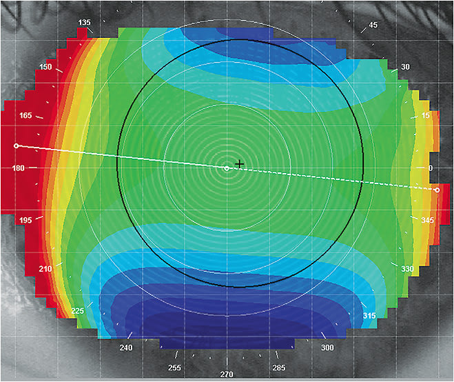 Figure 5. Elevation map showing a significant corneal elevation difference (496µm). The red portions of the elevation maps represent areas of the cornea that are higher in elevation. The blue portions represent the cornea that is lowest in elevation. The blue areas of the corneal elevation maps indicate the fluorescein pattern.