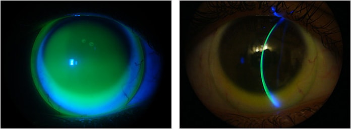 Figures 3 and 4. Fluorescein evaluation of the 16.5mm scleral lens.