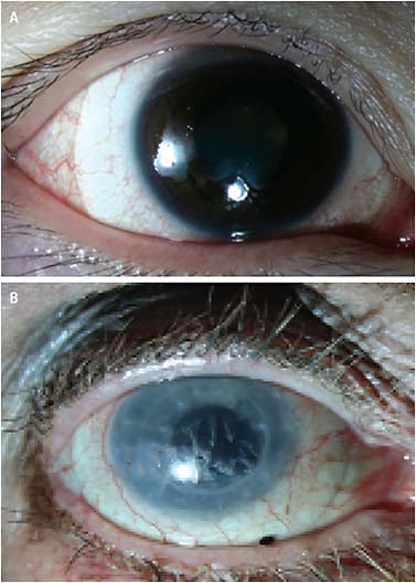 FIGURE 2. Top image demonstrates poor surface lens wetting, where tears do not evenly coat the lens surface; transient dry patches can disrupt visual quality (A). Bottom image demonstrates patches of mucus adhering to the lens surface (B). Sticky tear film debris can cling on the lens, contributing to blurred vision. Photos courtesy of Gloria Chiu, OD.