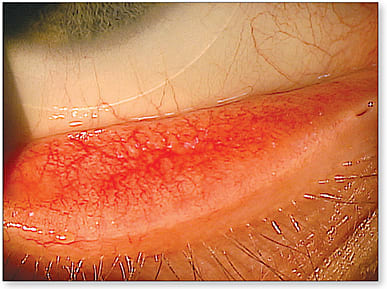 Figure 1. Mild hyperemia and fine papillae typical of PAC.