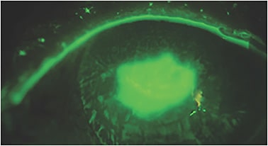 Figure 3. Longstanding persistent epithelial defect in a neurotrophic cornea.