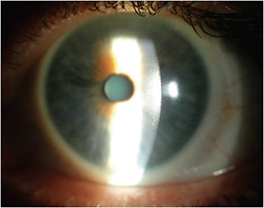 Figure 3. Uniform inter-blink surface drying leading to poor lubricity.