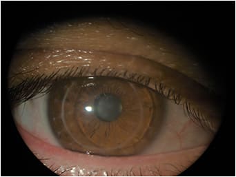 Figure 6. Slit lamp observation of the anterior cornea OD.