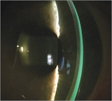 Figure 5. Prismatic fluid layer produced by a decentered scleral lens. Vertical decentration may induce a significant prismatic effect, which is a cause of residual astigmatism.