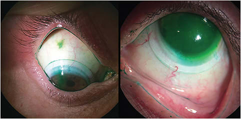 Figure 4. Vital staining of the lids in both eyes with lissamine green, indicating lid wiper epitheliopathy (LWE). (Left) The upper lid margin of the right eye showing severe LWE. (Right) The lower lid margin of the left eye showing moderate LWE. Fluorescein is also instilled at the same time, appearing as a green/yellow fluid reservoir in the inferior limbal area.