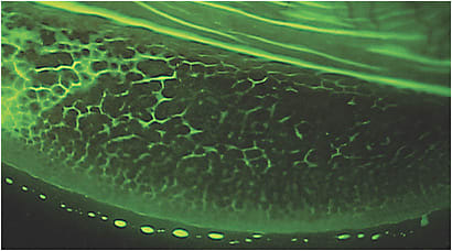 Figure 1. A patient who presented with mild-to-moderate inferior conjunctival papillae.