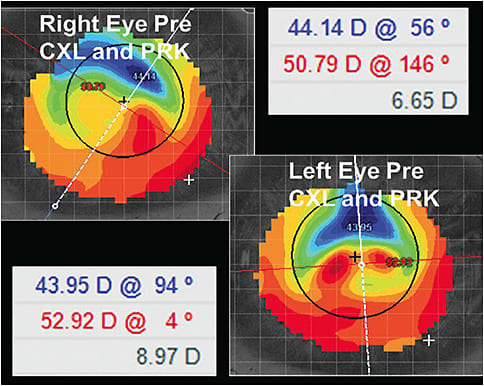 Figure 1. Right and left eye corneal topographies pre-CXL and PRK.