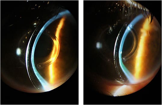 Figure 3. Scleral lens vault OD and OS with the scleral lenses at presentation.