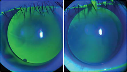 Figure 4. (Left) Initial flat-fitting lens showing temporal decentration. (Right) Centration was achieved by steepening the base curve radius for improved fitting on the cornea.