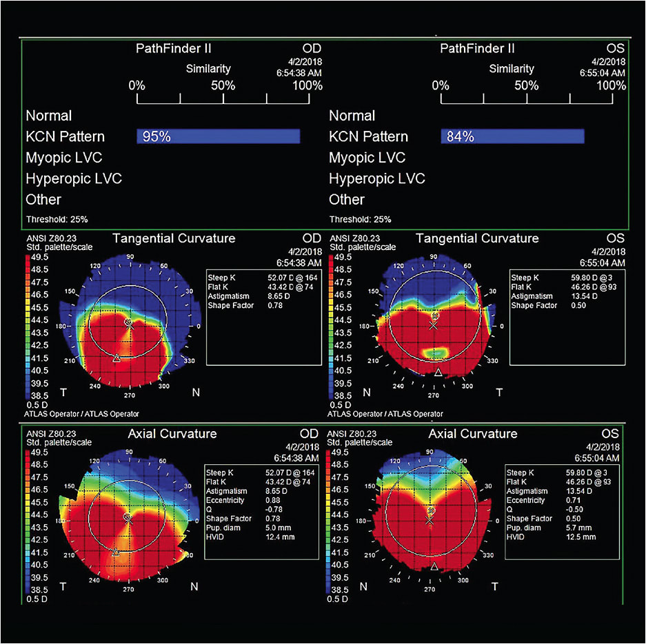 Figure 8. Patient who has a history of PMD. The instrument recognizes these topographies as keratoconus patterns and not normal. The axial and tangential maps demonstrate a “kissing doves” pattern.