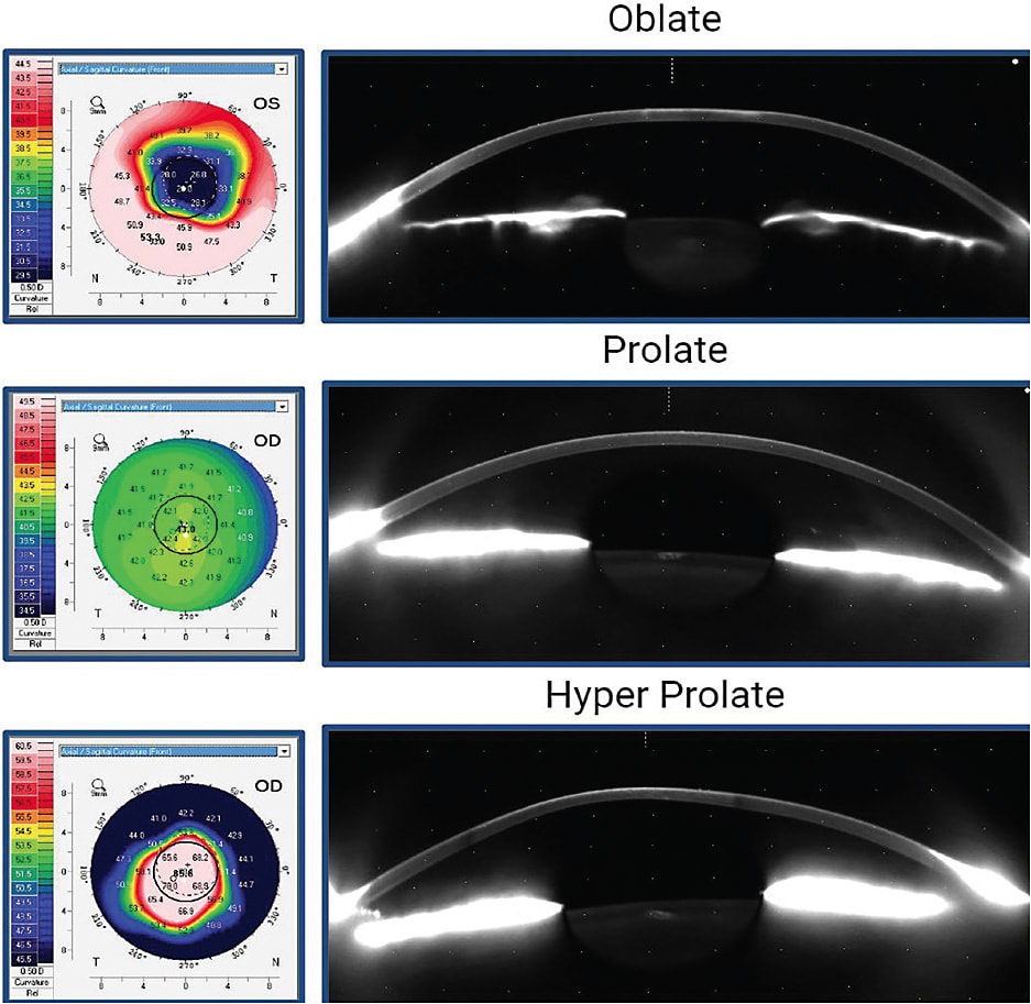 Figure 1. Corneal axial topography and cross sections derived from Scheimpflug tomography. The oblate cornea is post-radial keratotomy. The prolate cornea is a healthy normal cornea. The hyper-prolate cornea has keratoconus.