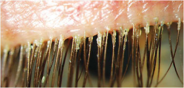 Figure 3. Demodex blepharitis with collarettes at base of eye lashes. 
Photo courtesy of Dr. William Ngo