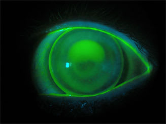 Figure 2. Keratoconus lens fit two years prior to the February 2011 follow-up visit. A central, apical touch is evident.