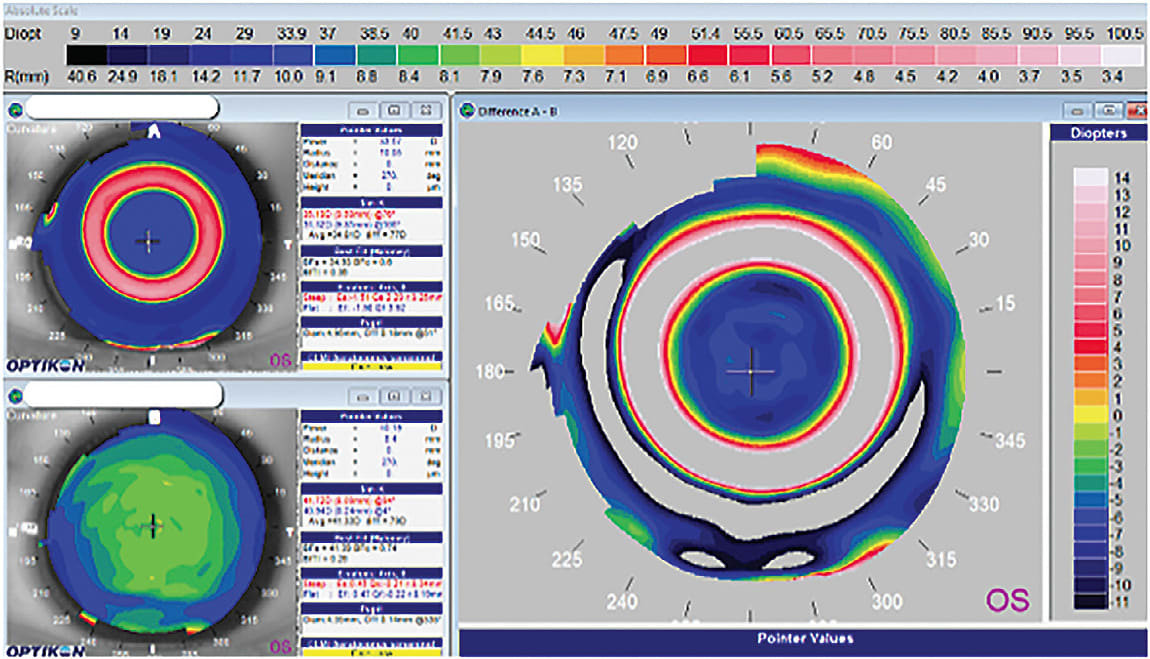 Figure 5. Orthokeratology treatment of a high myope with a custom empirically designed lens.