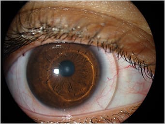 Figure 5. The 15.7mm scleral lens resulted in better centration.