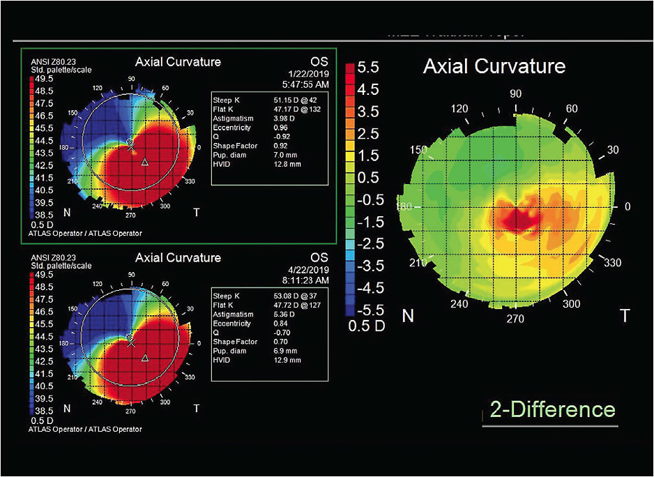 Figure 10. A difference map comparing two axial topography maps three months apart. The image on the right subtracts the two maps against each other. If there is no change, the color in that area will be green. If it is red, the cornea has steepened in that region; conversely, if it is blue, then the cornea has flattened.