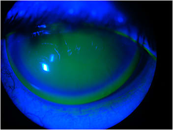 Figure 4. Final intralimbal GP lens OD.