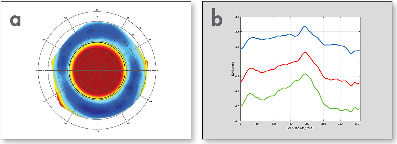 Figure 2. Scleral elevation map of a patient’s left eye (a). Asymmetric sagittal height plots of same patient at chord diameters of 14.7mm, 15.7mm, and 16.5mm (b).