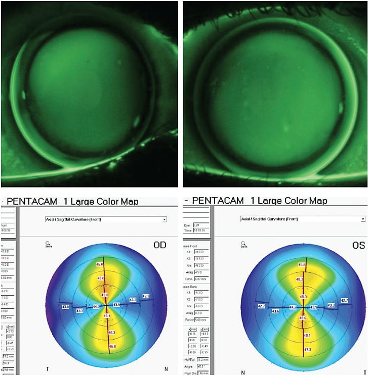 Figure 1. Well-aligned bitoric RGP over high corneal astigmatism.