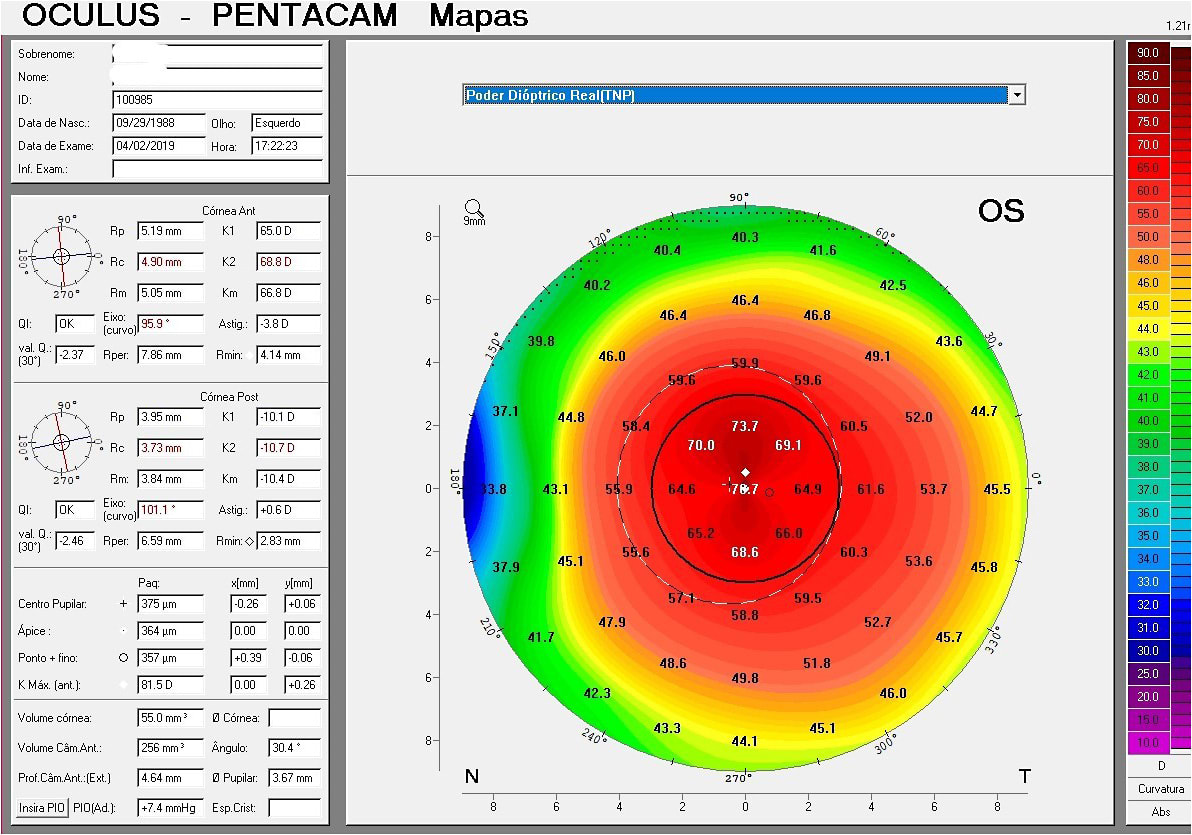 Figure 4. Topography map showing advanced keratoconus OS.