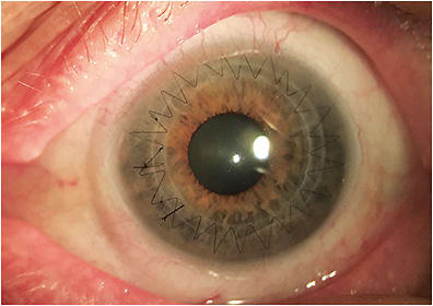 Figure 11. High-Dk silicone hydrogel soft contact lens fit on a three-month postoperative femtosecond laser-assisted PK.