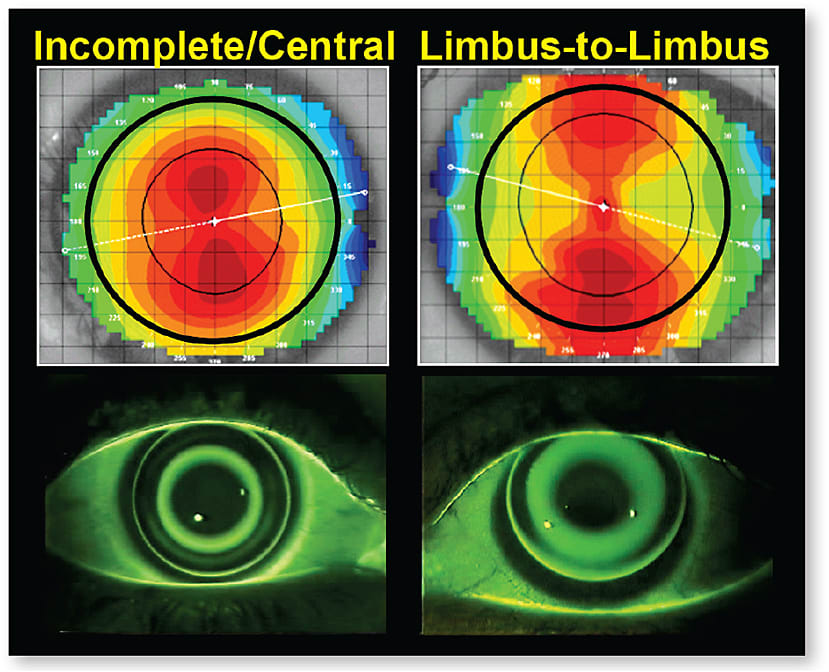 Figure 9. A spherical ortho-k lens can land properly and center on an eye with central astigmatism (left), but not on an eye with limbus-to-limbus astigmatism (right).