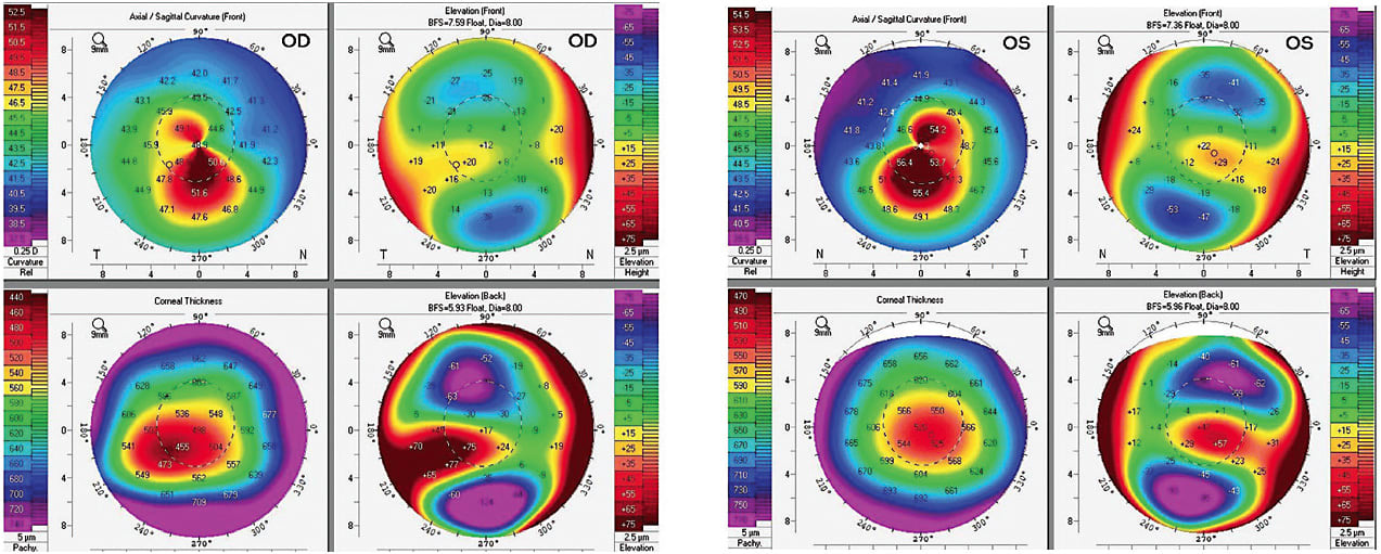 Figure 1. Tomography of the patient’s cornea.