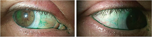 Figure 3. Conjunctival staining appearing in the nasal (left) and temporal (right) areas while assessing scleral lens fitting on the eye. A mild presence of lissamine green appears under the scleral lens periphery.