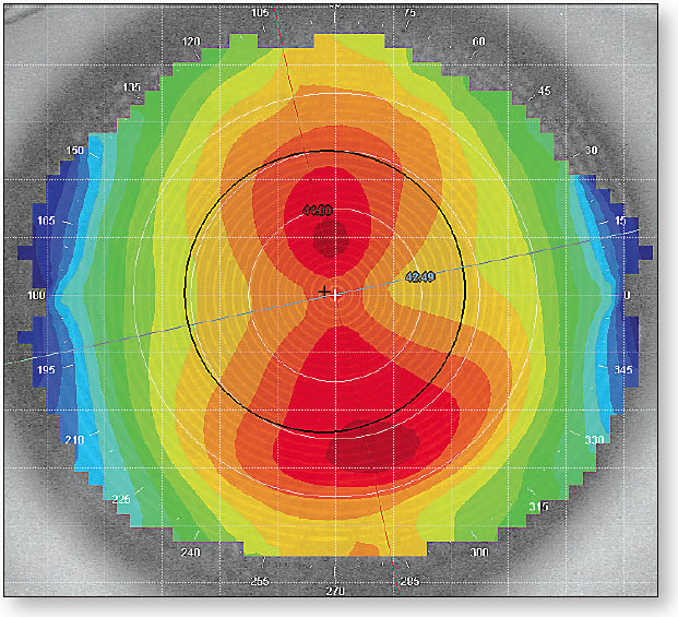 Figure 1. Baseline topography. Corneal Astigmatism: 1.47D