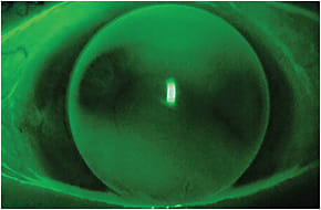 Figure 1. Spherical GP on a highly toric cornea.