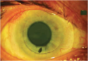 Figure 1. The 14.0mm diagnostic lens on the patient’s right eye.