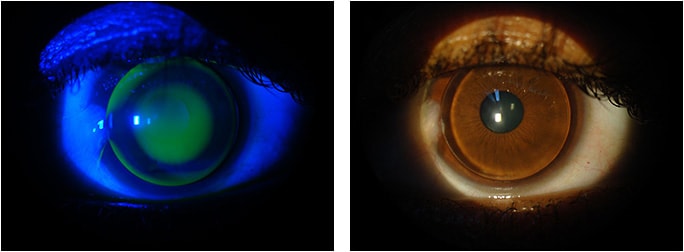 Figures 5 and 6, advanced keratoconus with pterygium OS, with and without fluorescein.