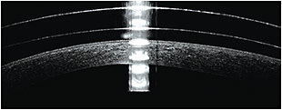 Figure 2. Vertical cross section of a scleral lens that is centered well vertically.