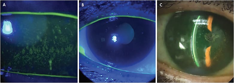 Figure 1. (A) Cornea of a Sjögren’s patient before scleral lens wear; (B) the same cornea after scleral lens wear; and (C) the scleral lens on the same eye. Photos courtesy of Karen Lee, OD