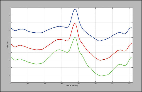 Figure 2. A sagittal height plot used to design the back surface haptic. The peak of the pinguecula is at 189°