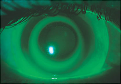 Figure 7. Corneoscleral ortho-k lenses can be designed to improve centration when treating challenging refractive errors. Photo courtesy of Daddi Fadel, DOptom