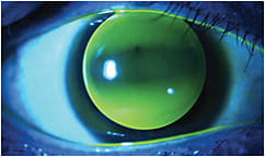 Figure 1. A spherical corneal GP lens on a highly toric cornea.