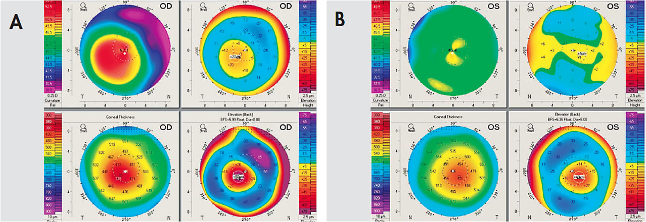 Figure 1. (A) OD: Clinically keratoconic and abnormal anterior corneal curvature, elevation, posterior elevation, and global pachymetry. (B) OS: Clinically normal and normal anterior curvature and elevation; however, abnormal posterior elevation and global pachymetry.