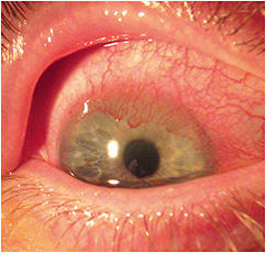 Figure 1. Right eye with vascularized keratitis upon initial presentation.