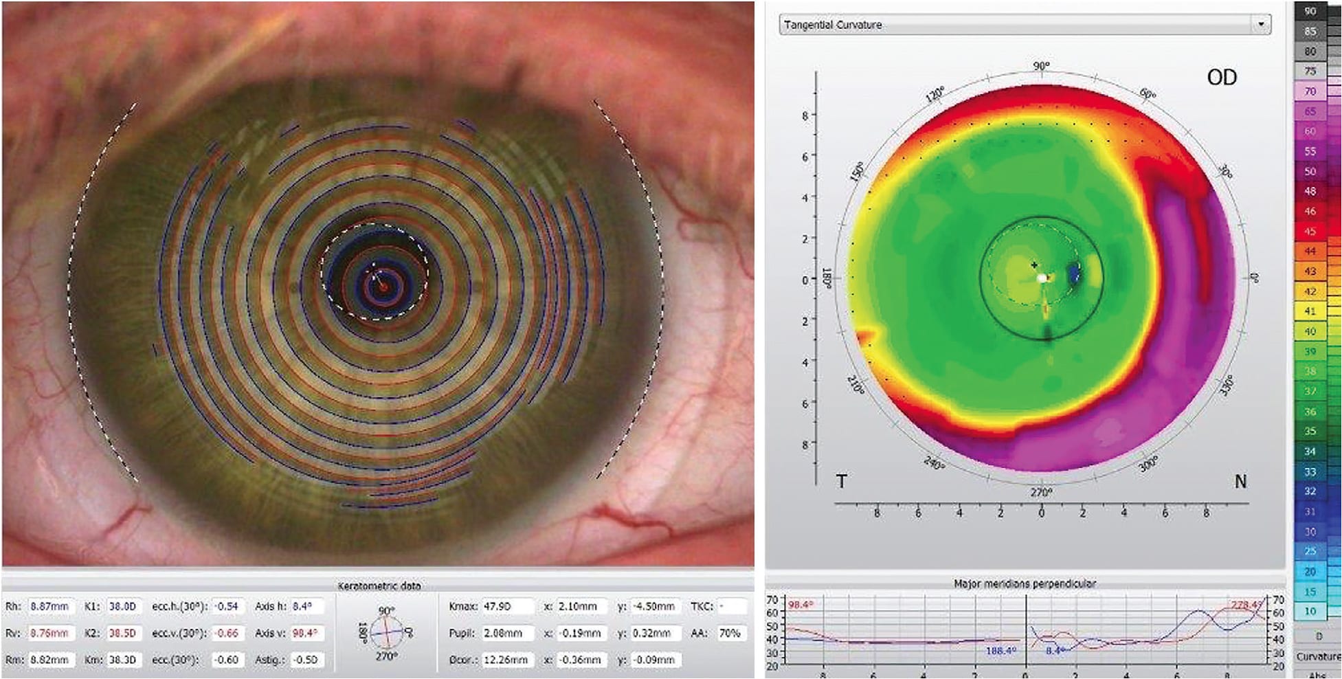 Figure 5. Decentration of a multifocal contact lens in situ measured with topography.