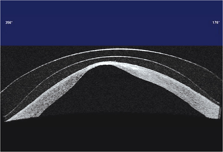 Figure 1. OCT image of a keratoconic cornea with a scleral contact lens. Note: the posterior elevation is greater compared to the anterior elevation. 
Photo courtesy of Edward Boshnick, OD, Miami, Florida