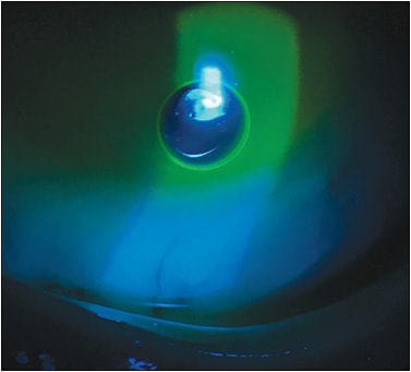 Figure 2. Inferior bubble in the post-lens fluid reservoir.